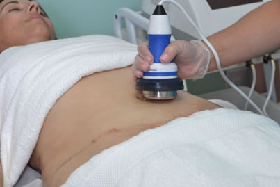 ultrasoundcavitation